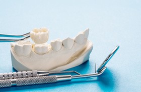 Odbudowa zęba – czym jest, jakie są metody i sposoby?