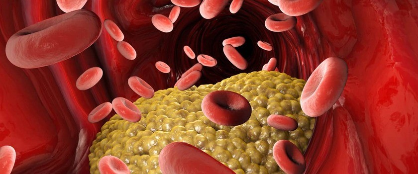 Hipercholesterolemia – przyczyny, objawy i leczenie. Czy jest groźna?