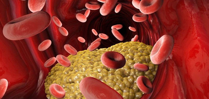 Hipercholesterolemia – przyczyny, objawy i leczenie. Czy jest groźna?