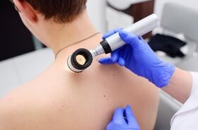 dermatoskopia, badanie znamion, badanie pieprzyków, badanie u dermatologa
