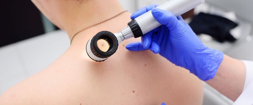 dermatoskopia, badanie znamion, badanie pieprzyków, badanie u dermatologa