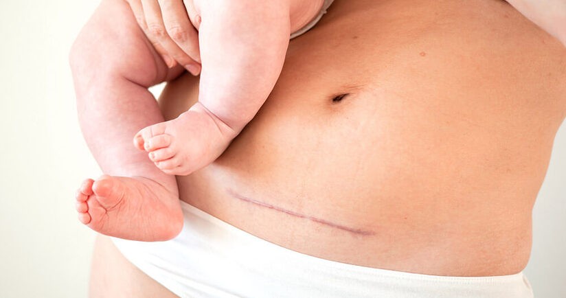 Właściwa pielęgnacja blizny po cesarskim cięciu obejmuje m.in. wiedzę czym smarować bliznę oraz jak masować bliznę.