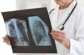 zapalenie płuc, lekarz ocenia rtg płuc, objawy zapalenia płuc, 