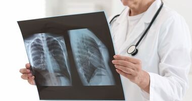 zapalenie płuc, lekarz ocenia rtg płuc, objawy zapalenia płuc, 