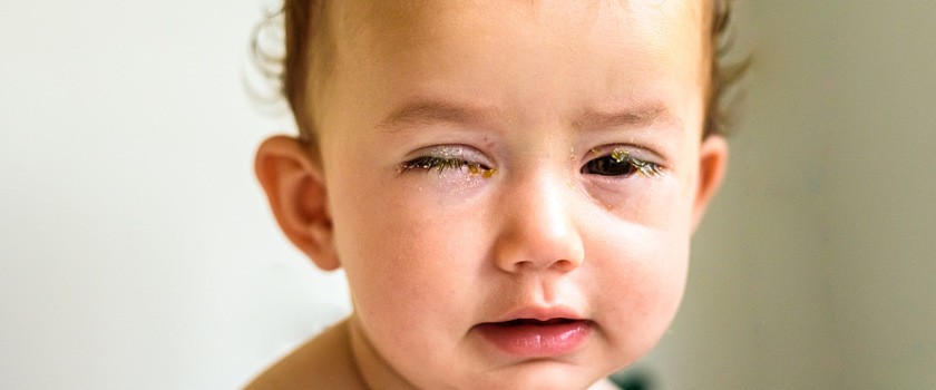 Zapalenie spojówek u dzieci – przyczyny, objawy, leczenie