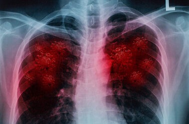 Powikłania COVID-19. Jak koronawirus niszczy nasze płuca?