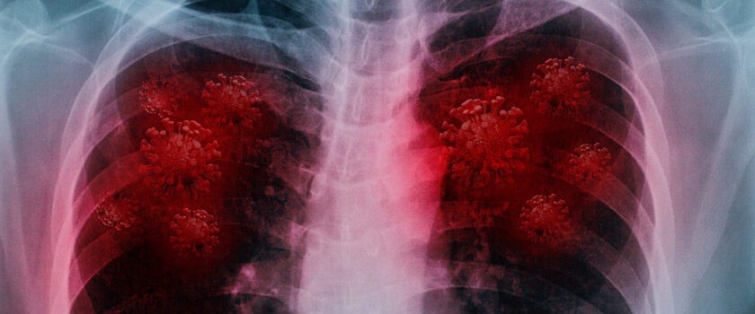 Powikłania COVID-19. Jak koronawirus niszczy nasze płuca?
