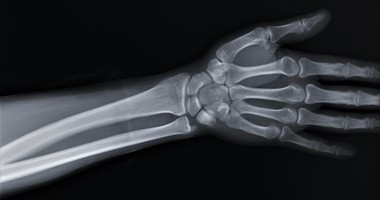 Kość łódeczkowata – objawy, leczenie i rehabilitacja w złamaniach kości łódeczkowatej