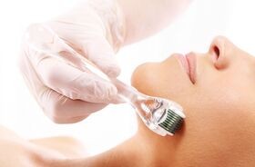 Domowa terapia mikroigłowa