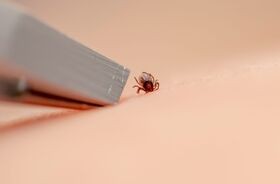 usuwanie kleszcza za pomocą pęsety