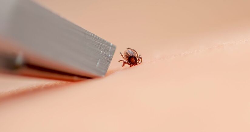 usuwanie kleszcza za pomocą pęsety