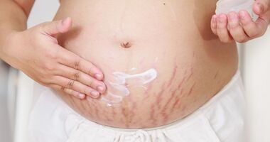 rozstępy w fazie zapalnej, rozstępy na brzuchu ciążowym