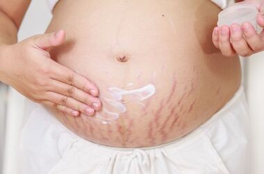 rozstępy w fazie zapalnej, rozstępy na brzuchu ciążowym