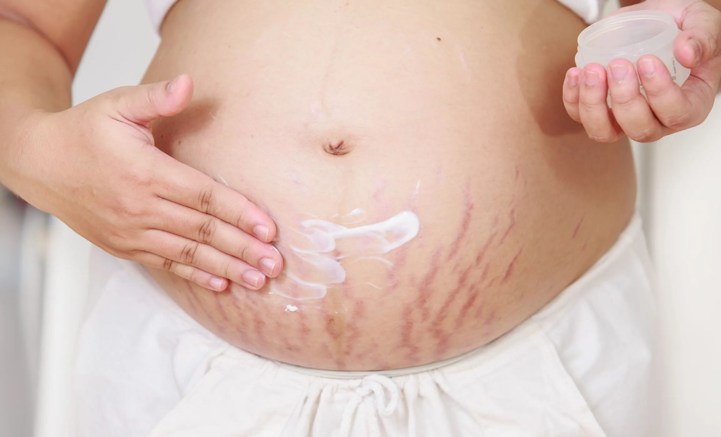 rozstępy w fazie zapalnej, rozstępy w ciąży