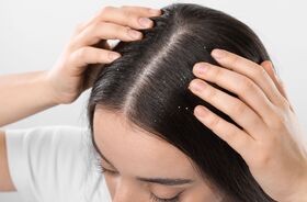 łupież, łupież skóry głowy, kobieta z łupieżem na ciemnych włosach