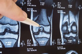 Endoproteza kolana – wskazania, przebieg zabiegu, rehabilitacja po endoprotezoplastyce stawu kolanowego