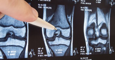 Endoproteza kolana – wskazania, przebieg zabiegu, rehabilitacja po endoprotezoplastyce stawu kolanowego
