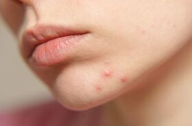 zaskórniki, zaskórniki otwarte, cera trądzikowa, twarz kobiety z zaskórnikami otwartymi na brodzie