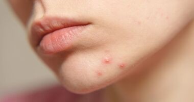 zaskórniki, zaskórniki otwarte, cera trądzikowa, twarz kobiety z zaskórnikami otwartymi na brodzie