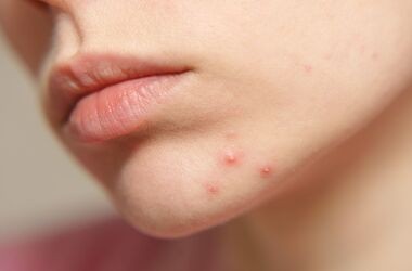 zaskórniki, zaskórniki otwarte, cera trądzikowa, twarz kobiety z zaskórnikami otwartymi na brodzie