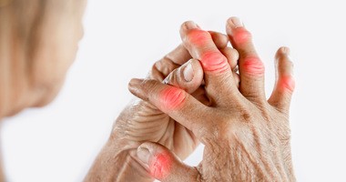 Ręka kobiety cierpiącej na ból stawów spowodowany dną moczanową