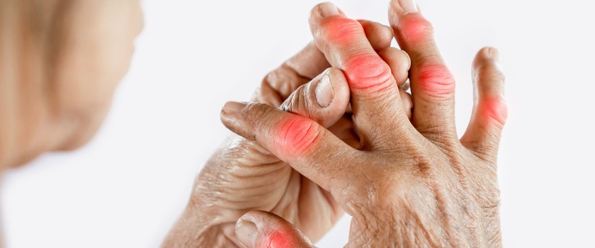 Ręka kobiety cierpiącej na ból stawów spowodowany dną moczanową