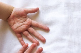 ręka dziecka z wysypką wywołaną wirusem coxsackie