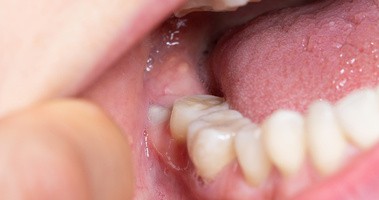 Wyrzynający się ząb mądrości widoczny w jamie ustnej
