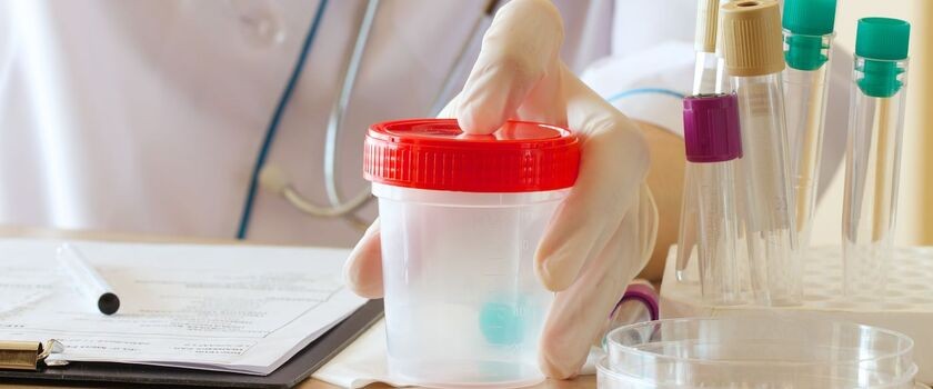 Pojemniki na mocz na biurku medyka. Badanie ogólne moczu, ogólne badanie moczu, badanie moczu normy.