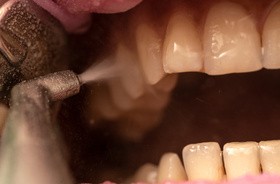 Piaskowanie zębów – czym jest, jakie są wskazania i efekty?