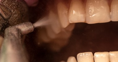 Piaskowanie zębów – czym jest, jakie są wskazania i efekty?