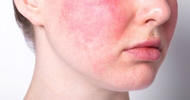 trądzik różowaty, objawy trądziku różowatego, kobieta z trądzikiem różowatym,