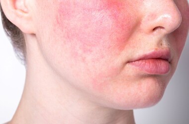 trądzik różowaty, objawy trądziku różowatego, kobieta z trądzikiem różowatym,