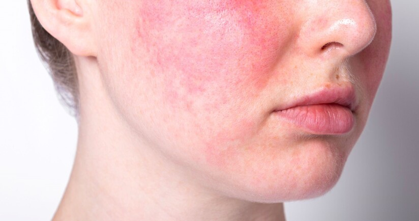trądzik różowaty, objawy trądziku różowatego, kobieta z trądzikiem różowatym,