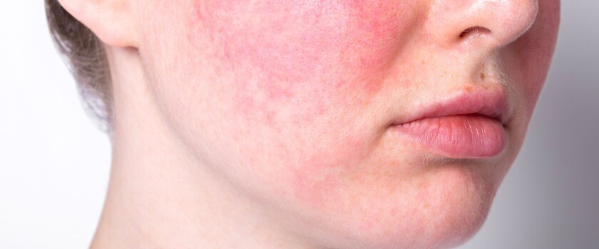 trądzik różowaty, objawy trądziku różowatego, kobieta z trądzikiem różowatym,