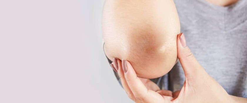 Domowe sposoby na „brudne” łokcie i kolana – jak pozbyć się problemu rogowaciejącej skóry?