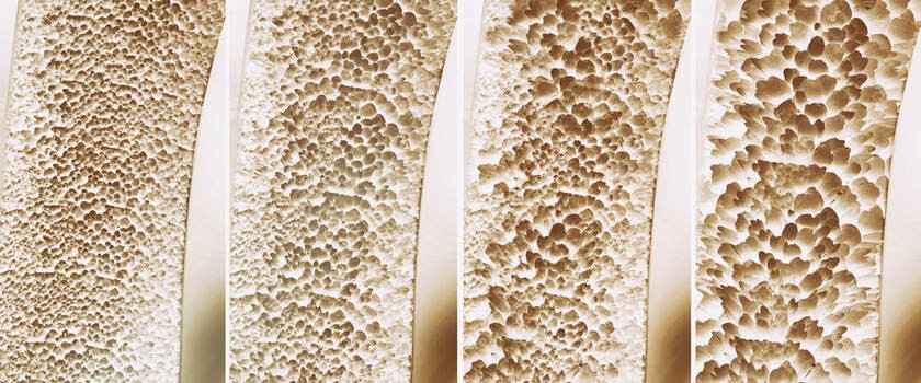 Osteoporoza – przyczyny, objawy, badania, leczenie, rehabilitacja, zapobieganie zmianom osteoporotycznym