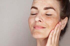 Kobieta z przebarwieniami na twarzy - melasma