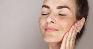 Kobieta z przebarwieniami na twarzy - melasma