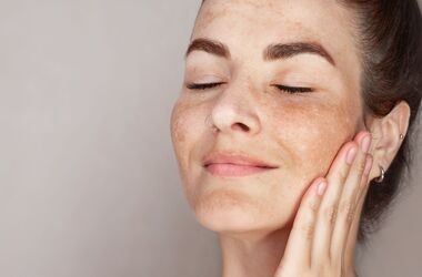 Kobieta z przebarwieniami na twarzy - melasma