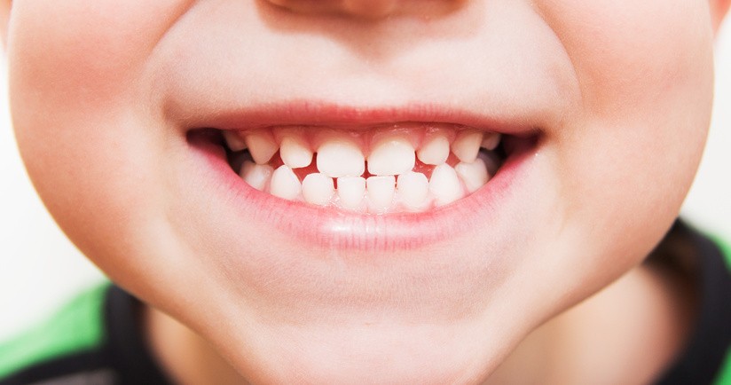 Lakowanie zębów u dzieci – czy jest konieczne?