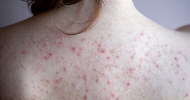 trądzik na plecach, plecy z trądzikiem, jak leczyć trądzik na plecach