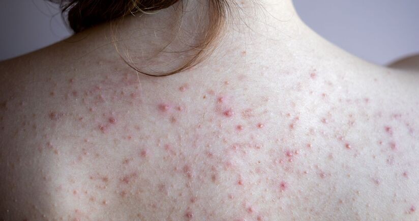 trądzik na plecach, plecy z trądzikiem, jak leczyć trądzik na plecach