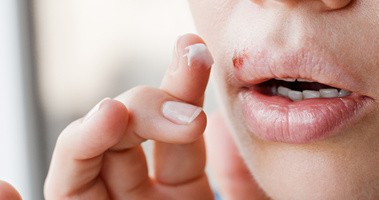 Opryszczka na ustach – leczenie, przyczyny i objawy. Czy można skrócić czas leczenia „zimna" na ustach?