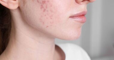 Kobieta cierpiąca na trądzik pospolity (acne vulgaris).