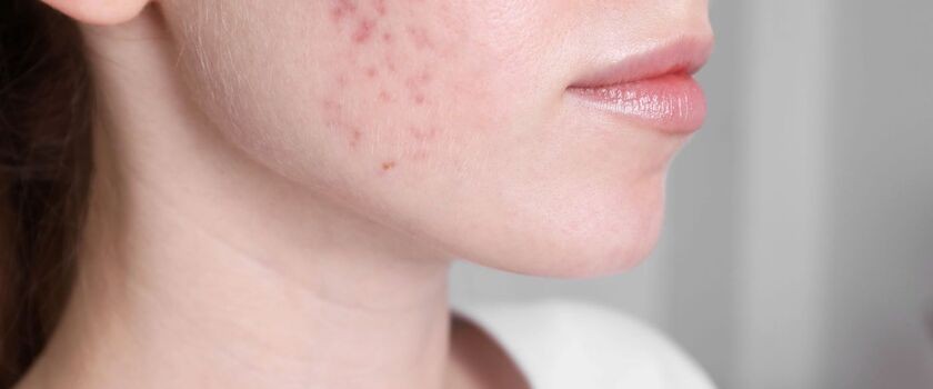 Kobieta cierpiąca na trądzik pospolity (acne vulgaris).