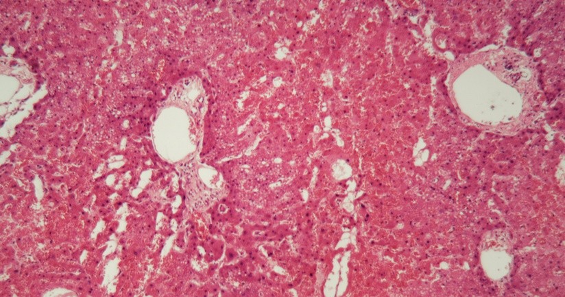 Amyloidoza (skrobiawica) – przyczyny, objawy, diagnoza i leczenie