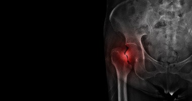 Złamania osteoporotyczne – czym się charakteryzują i kto jest na nie najbardziej narażony?