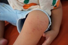 wysypka u dziecka, przyczyny wysypki u dziecka, skąd wysypka u dzieci