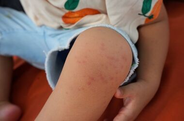 wysypka u dziecka, przyczyny wysypki u dziecka, skąd wysypka u dzieci